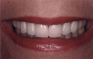 Woman's darkened teeth repaired with Empress crowns veneers and bridge