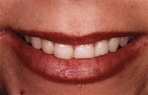 Woman with short stubby front teeth