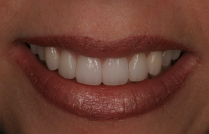 Woman's short teeth rebuilt with Empress veneers