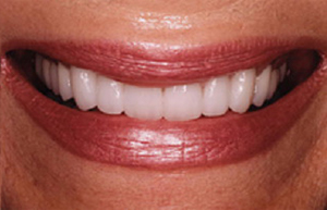 Woman's discolored teeth enhanced with veneers and porcelain to gold restorations