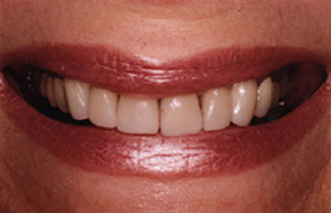 Yellowed teeth with dark stains between