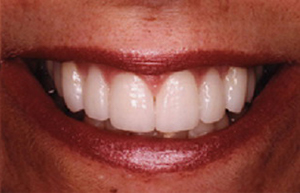 Woman with eight front teeth repaired with empress eris restorations