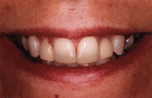 Woman with worn and thin tooth enamel
