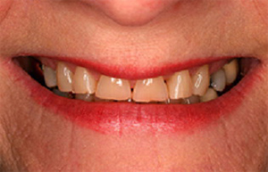 Yellowed worn teeth with gaps between