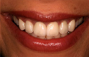 Front teeth corrected with six dental crowns