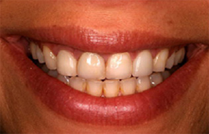 Front teeth with discolored fillings and wear