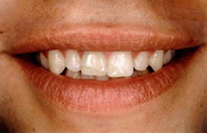 Man's smile with two damaged teeth