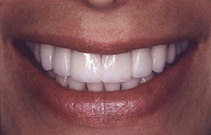 Woman's smile repaired with eight Empress Veneers