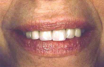 Front teeth with two different sized dental crowns