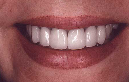 Repaired smile with completely natural looking porcelain to gold dental crowns