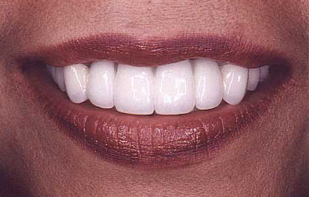 Flawless white smile following porcleain veneers and porcelain to gold dental crowns and fixed bridge restorations
