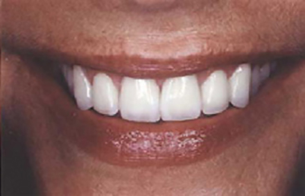 Smile with natural looking porcelain to gold bridge empress crowns and composite restorations