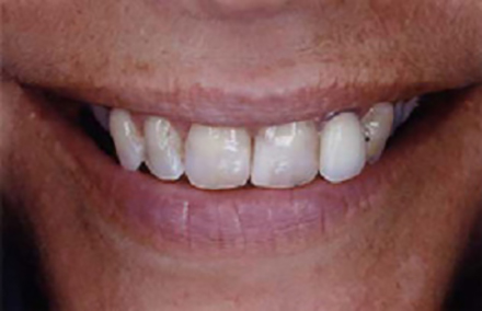 Woman with dental discoloration and a damaged crown