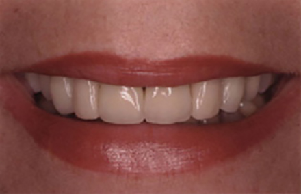 Woman's smile with yellowing front teeth