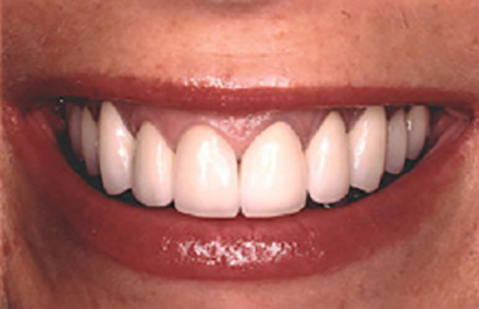 Beautiful smile following gum recontouring and porcelain to gold crowns
