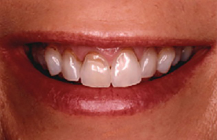 Smile with receding gums and stained teeth