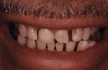 Numerous damaged and misshapen upper and lower teeth