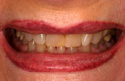 Short and dark yellow front teeth