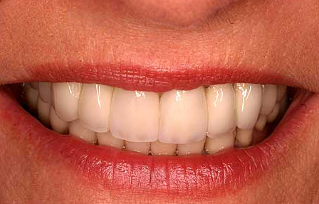 Natural looking dental crowns and porcelain to gold fixed bridge tooth replacement