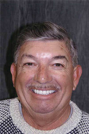 Man with properly aligned and positioned teeth after transformation