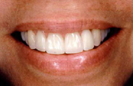 Woman's teeth with Empress veneer-crown restoration