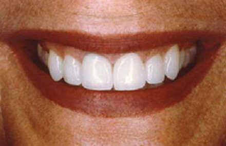Woman with flawless healthy smile after restoration with empress veneers and crowns