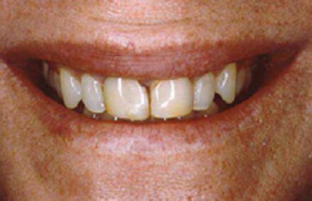 Woman's two front teeth discolored and cracked