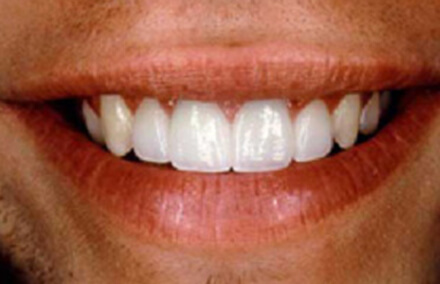 Man's front tooth repaired with Empress crown and veneers