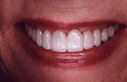 Natural looking Empress crown repaired tooth