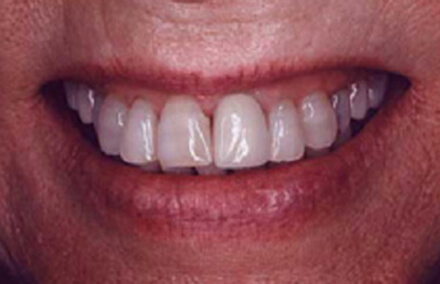 Damaged left front tooth discolored at gums