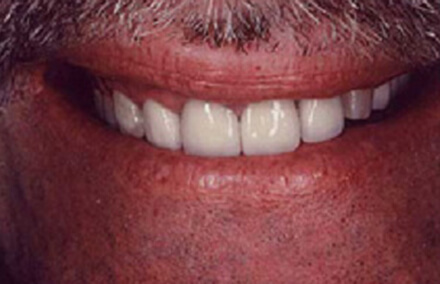 Man's unnatural looking front teeth dental crowns