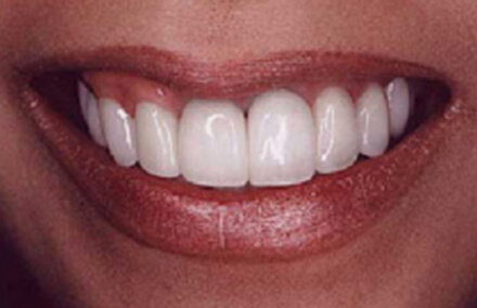Perfect bright smile with dental crowns
