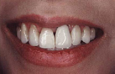 Teeth with dark lines at gums