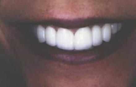 Smile with healthy beautiful teeth and gums after empress dental restorations and dental implant tooth replacement