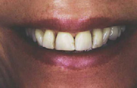 Woman with receding gums and discolored teeth