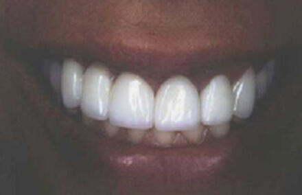 Woman's brilliant white perfect smile after gum tissue healing and dental crown restoration