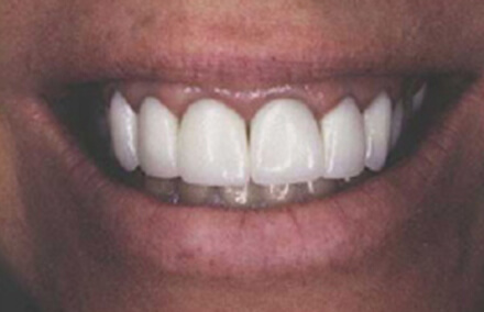 Woman's unnatural looking dental crowns