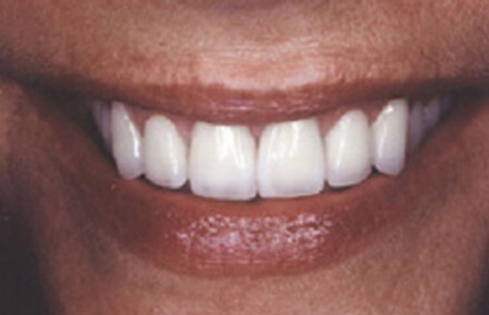 Woman's smile repaired with Empress restorations