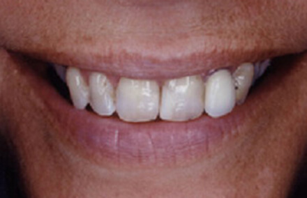 Woman's smile with badly worn front teeth