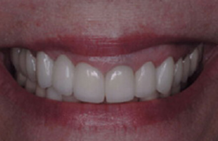 Perfected white smile with Empress bridge