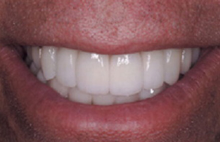 Properly sized bright white smile after empress two dental crowns and fixed bridge placement