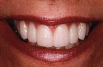 Strong healthy white teeth and flawless smile after empress eris restoration