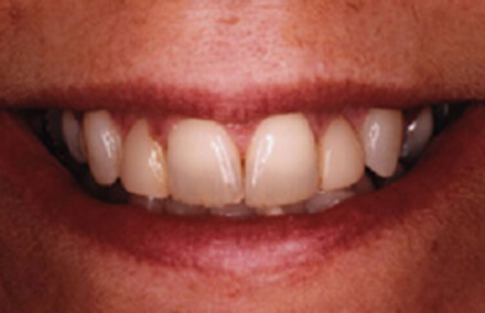 Discolored teeth thin near biting surface