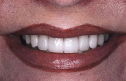 Woman's smile with flawless natural looking empress veneers and crowns