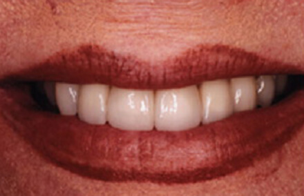 Woman's smile with unnatural looking front crowns