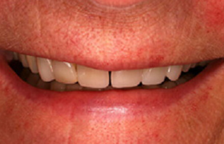 Poorly crafted front tooth crown gap between teeth