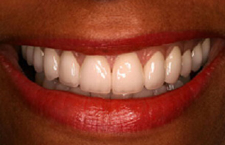 Smile with flawlessly aligned teeth after porcelain lava crown restoration