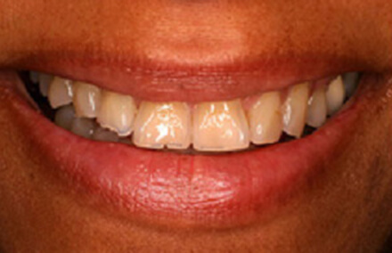 Smile with shorter teeth on left side