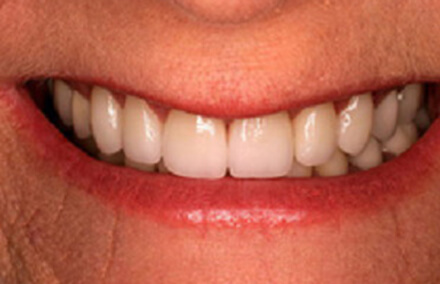 Evenly spaced white toothed smile after empress veneers lava crowns and porcelain to gold dental bridge