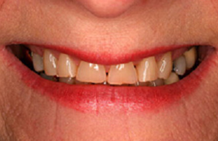 Yellow smile with severely worn teeth